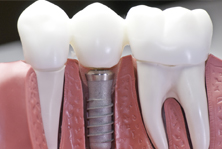 Dental Implants Richmond