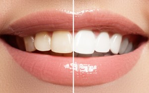 teeth-whitening